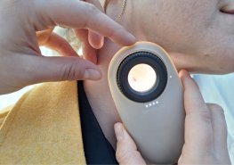 O dny melanomu byl rekordní zájem. Znaménka si v Pardubicích a Litomyšli nechalo zkontrolovat téměř 1100 lidí